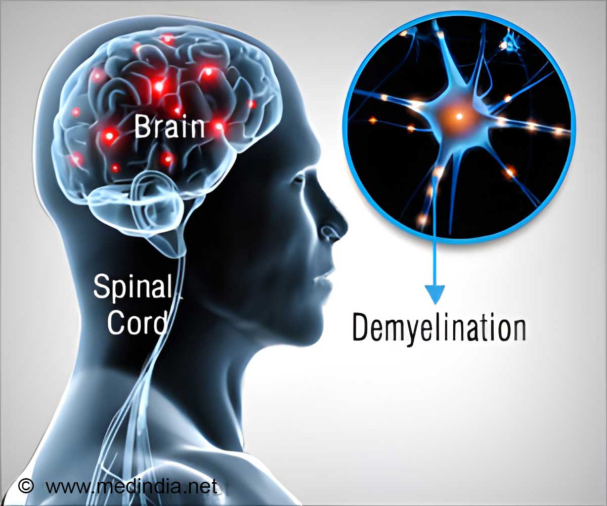 Predictive Biomarkers in Multiple Sclerosis Management